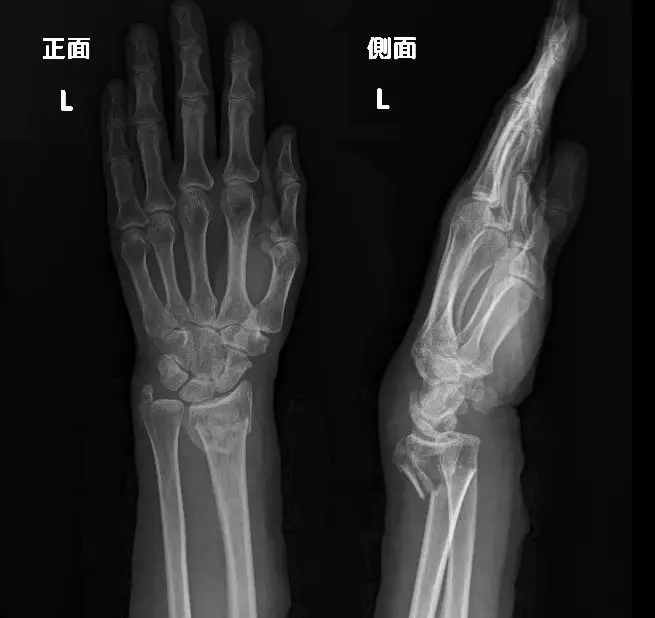 X-ray of Trudy's broken arm