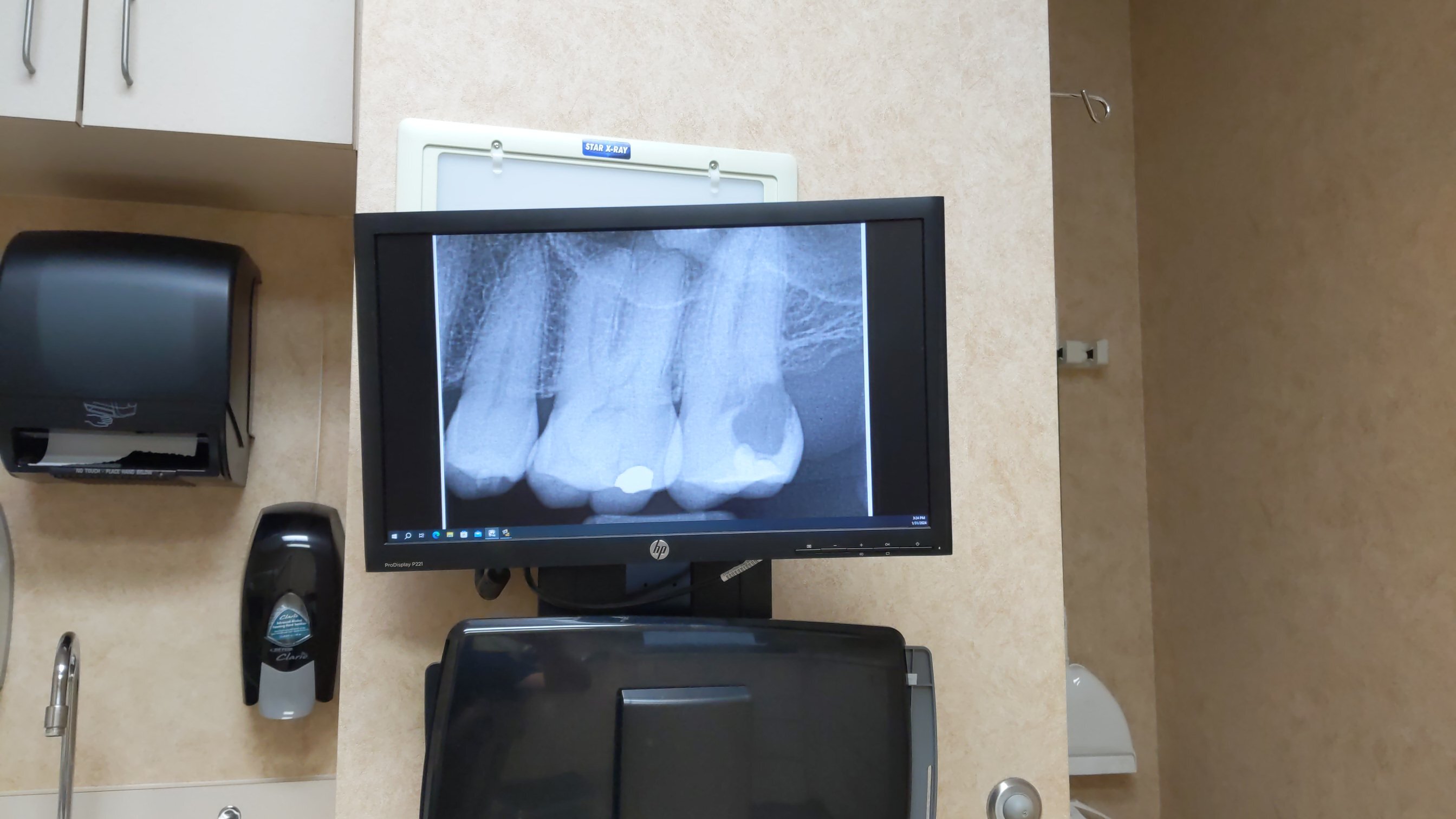 An xray of my teeth showing a very back tooth with severe resorption issues.